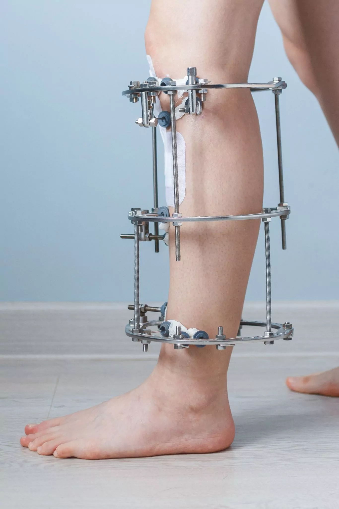 Método de Ilizarov - fixador externo circular