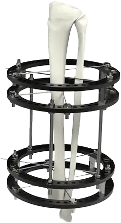 Modelo 3D do fixador de Ilizarov aplicado ao osso